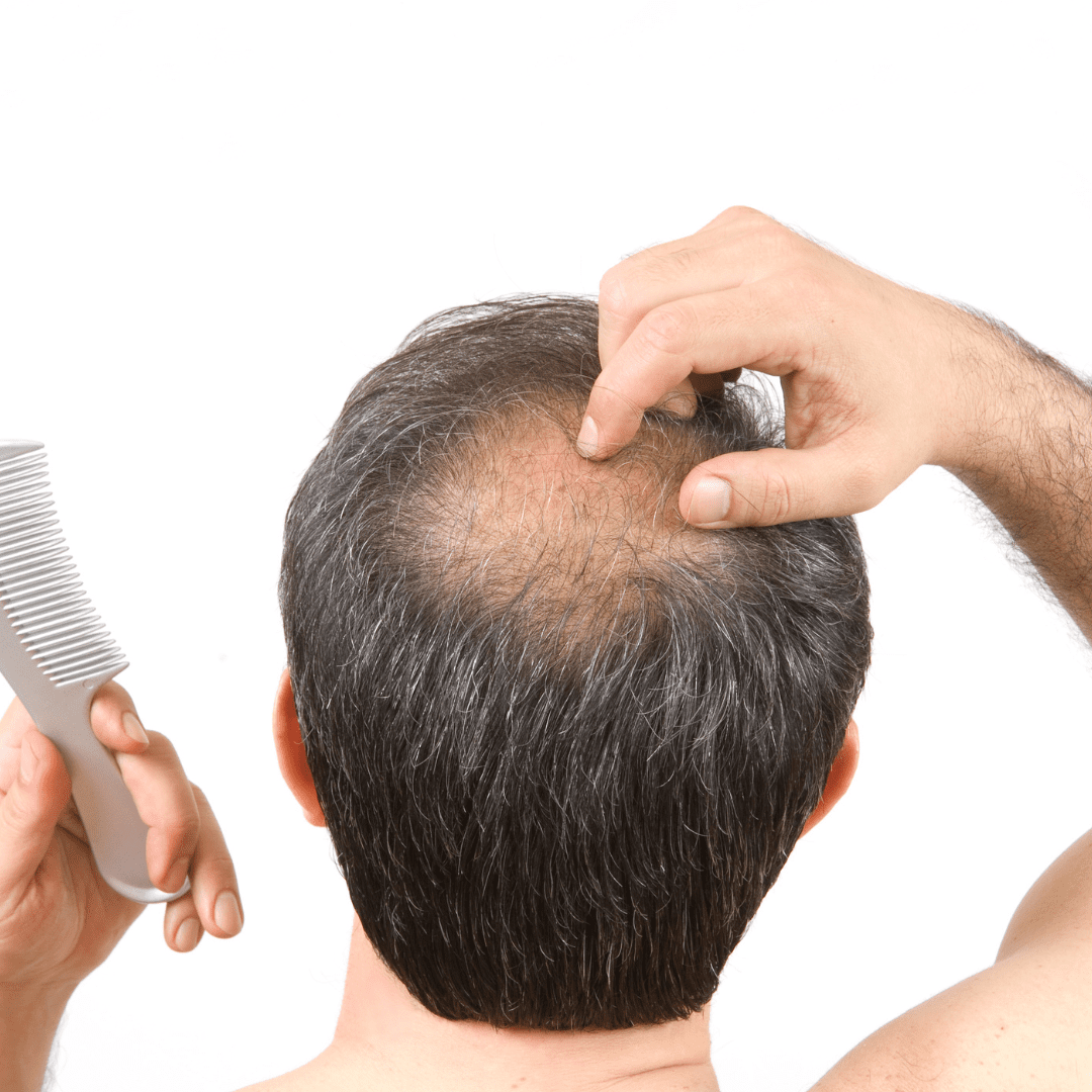 A calvície masculina tem cura?